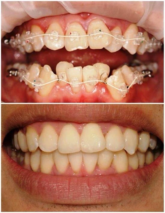 OHHC patient braces treatment — during treatment and finished result