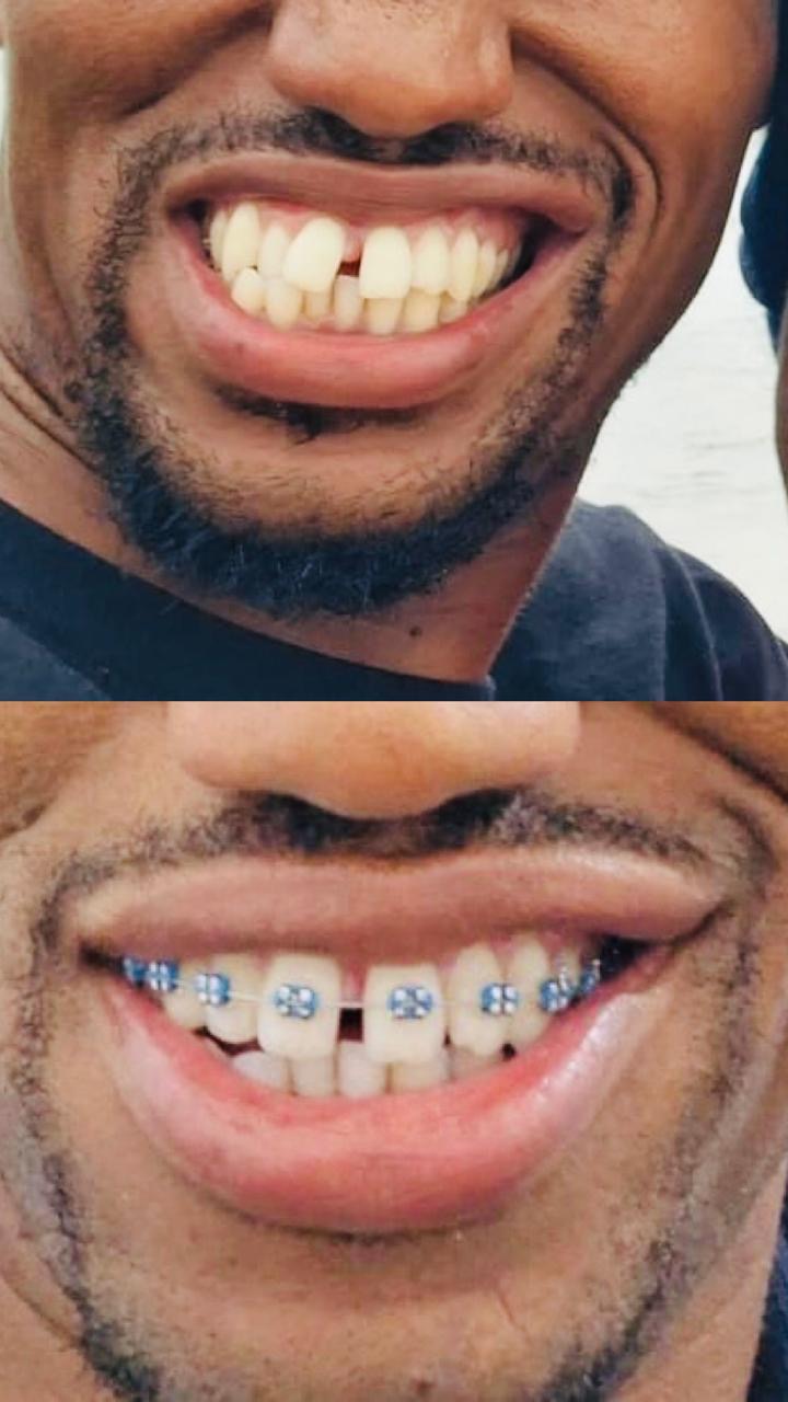 OHHC patient braces treatment — before and during orthodontic correction