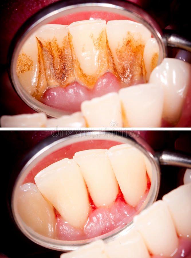 OHHC patient scaling and polishing treatment — before and after tartar removal