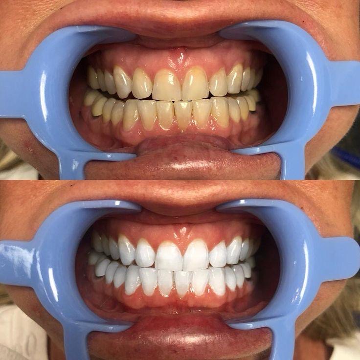 OHHC patient tooth whitening treatment — before and after results